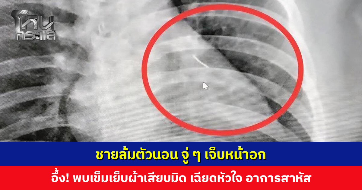 ชายล้มตัวนอน จู่ ๆ เจ็บหน้าอก อึ้ง! พบเข็มเย็บผ้าเสียบมิด เฉียดหัวใจ อาการสาหัส