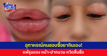 อุทาหรณ์คนชอบซื้อยากินเอง! หญิงวัย 39 ปวดเมื่อย ซื้อยากิน สุดท้ายแพ้รุนแรง หน้า-ปากบวม