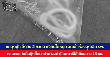 ขนลุกซู่! เด็กวัย 2 ขวบอาเจียนไม่หยุด จนเข้าห้องฉุกเฉิน รพ. ก่อนเจอเส้นดิ้นดุ๊กดิ๊กคาปาก ผงะ! เป็นพยาธิไส้เดือนยาว 15 ซม.