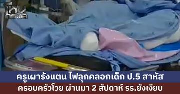 ครูเผารังแตน ไฟลุกคลอกเด็ก ป.5 เจ็บสาหัส ครอบครัวโวย ผ่านมา 2 สัปดาห์ รร.ยังเงียบ จี้เยียวยา