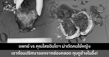 แพทย์หาดใหญ่ผ่าตัดนำก้อนปริศนาออกจากช่องคลอดหญิงวัย 47 ทุบดูข้างในอึ้ง! มีแต่ดิน โคลน ลูกปัด