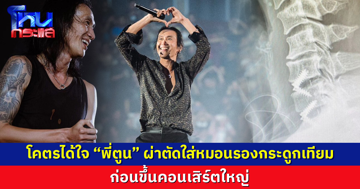 โคตรได้ใจ “พี่ตูน” ผ่าตัดเปลี่ยนใส่หมอนรองกระดูกเทียม ก่อนขึ้นคอนเสิร์ตใหญ่ 