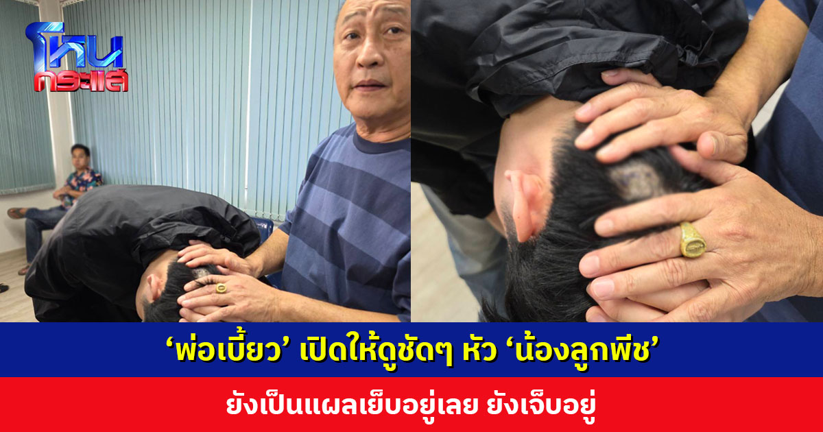 ‘พ่อเบี้ยว’ เปิดให้ดูชัดๆ หัว ‘น้องลูกพีช’ ยังเป็นแผลเย็บอยู่เลย ยังเจ็บอยู่