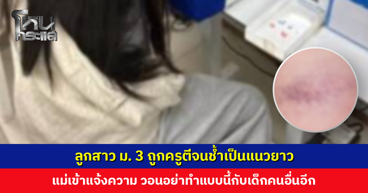 แม่แจ้งความ ลูกสาว ม. 3 ส่งงานไม่ครบ ถูกครูตีจนช้ำเป็นแนวยาว