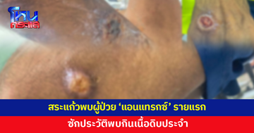 สระแก้วพบผู้ป่วย 'แอนแทรกซ์' รายแรก ซักประวัติพบกินเนื้อดิบประจำ