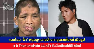 เผยโฉม ‘ฟ้า’ หนุ่มถูกนายจ้างทำร้ายทารุณจนใบหน้าผิดรูป ผ่านไป 4 ปี วันนี้เหมือนได้ชีวิตใหม่