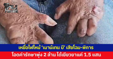 เหยื่อไฟไหม้ 'เมาน์เทน บี' เสียโฉม-พิการ โอดค่ารักษาพุ่ง 2 ล้าน แต่ได้เยียวยาแค่ 1.5 แสน
